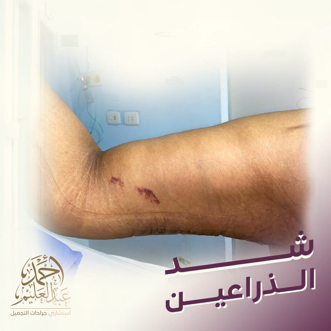 شد الذراعين بعد فقدان الوزن