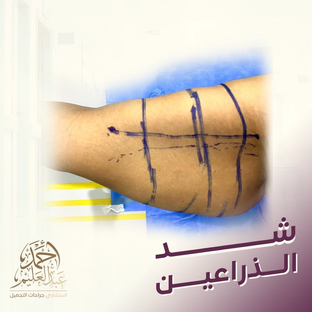 شد الذراعين قبل