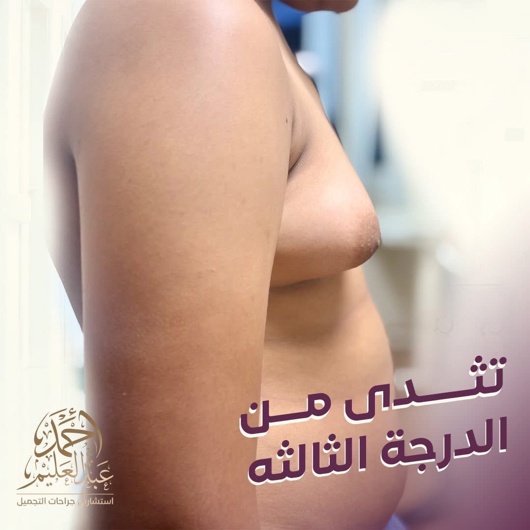 تثدي درجة ثالثة بعد