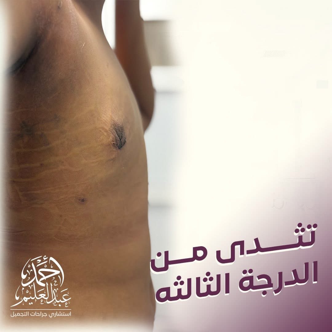 تثدي درجة ثالثة قبل