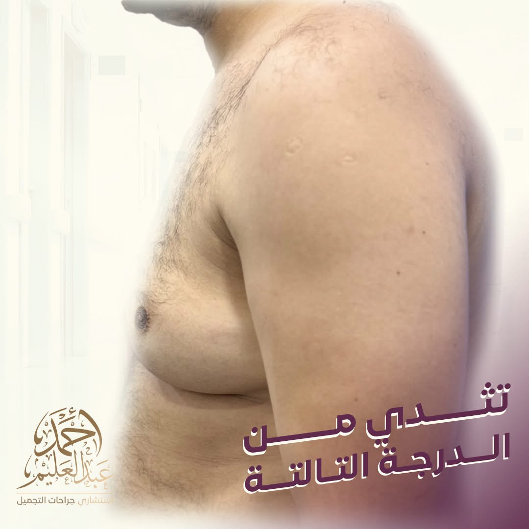 بعد علاج التثدي