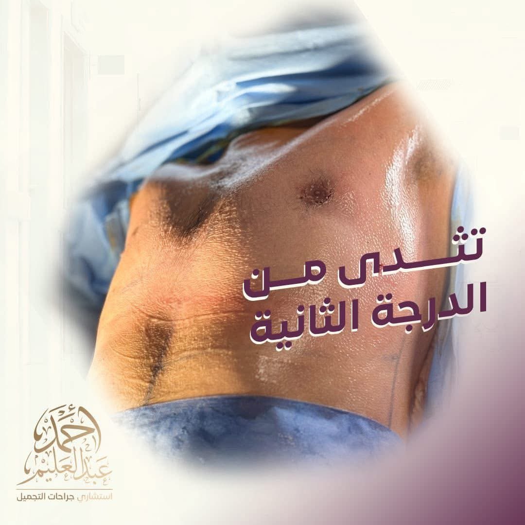 علاج التثدي عند الرجال