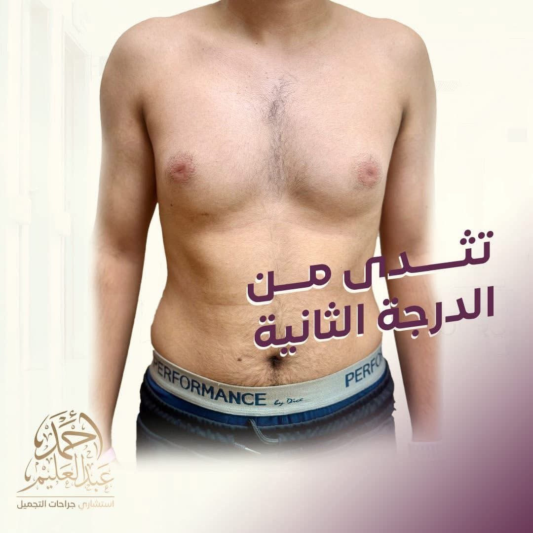 تثدي درجة ثانية قبل