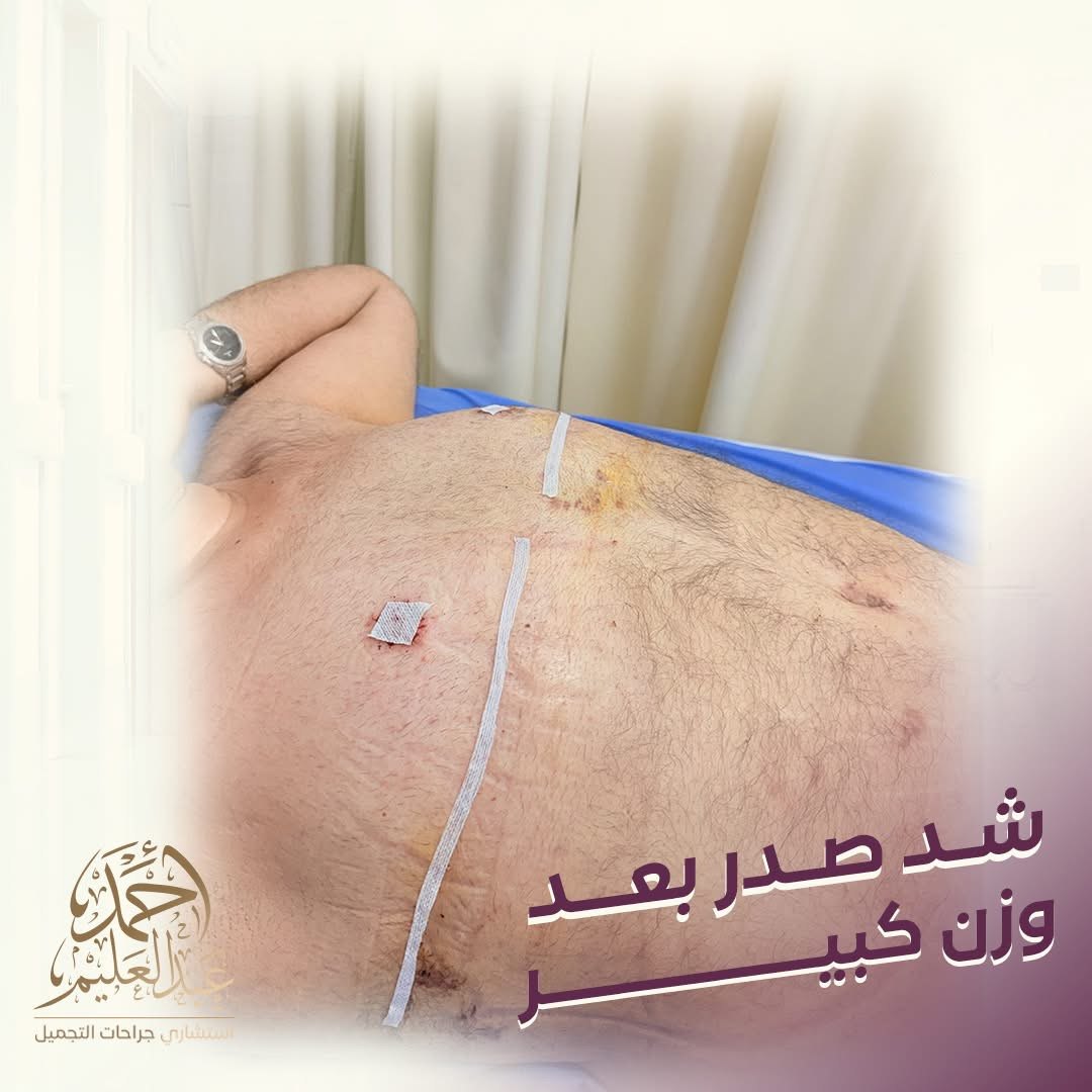 بعد شد الجسم بعد فقدان الوزن