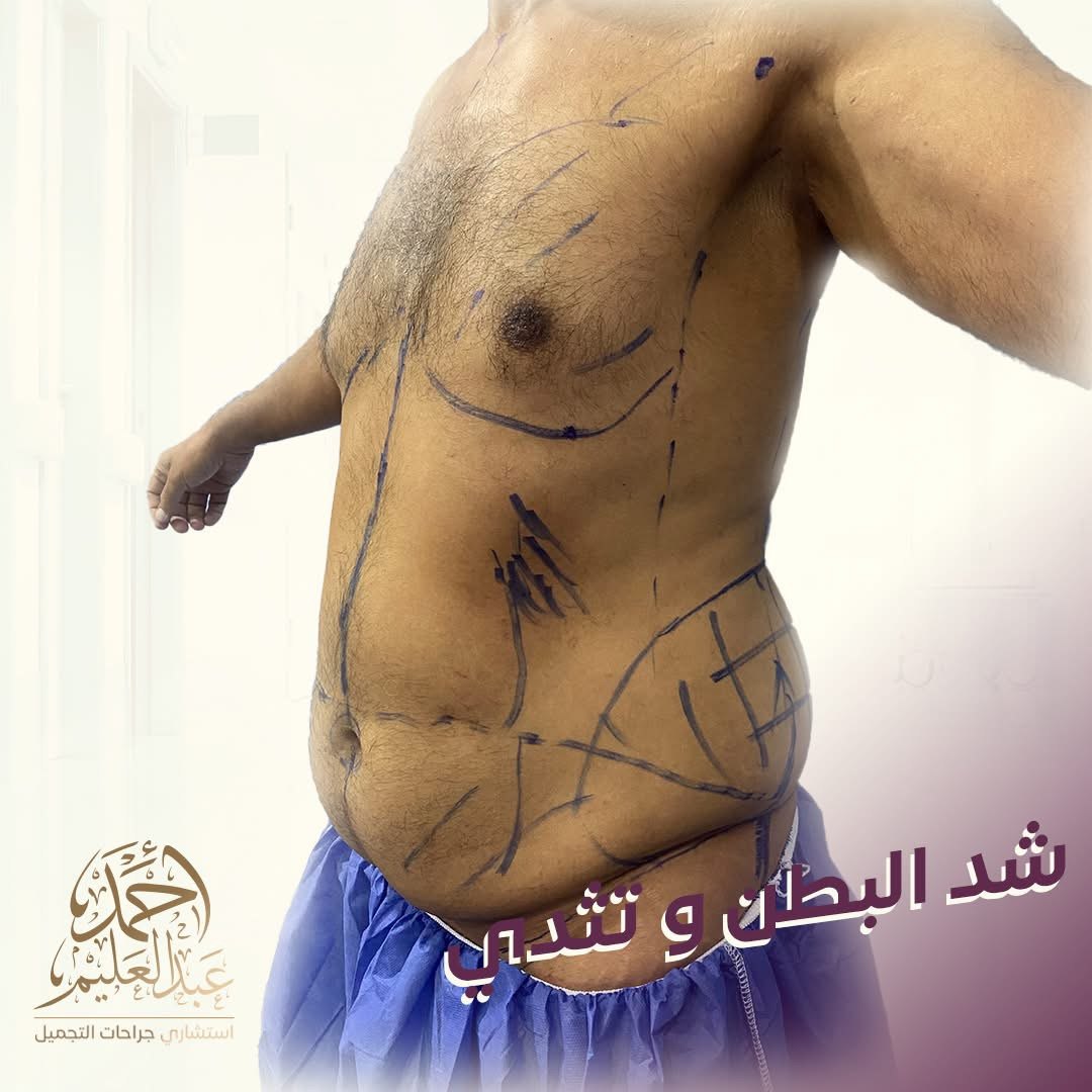 قبل شد البطن والتثدي