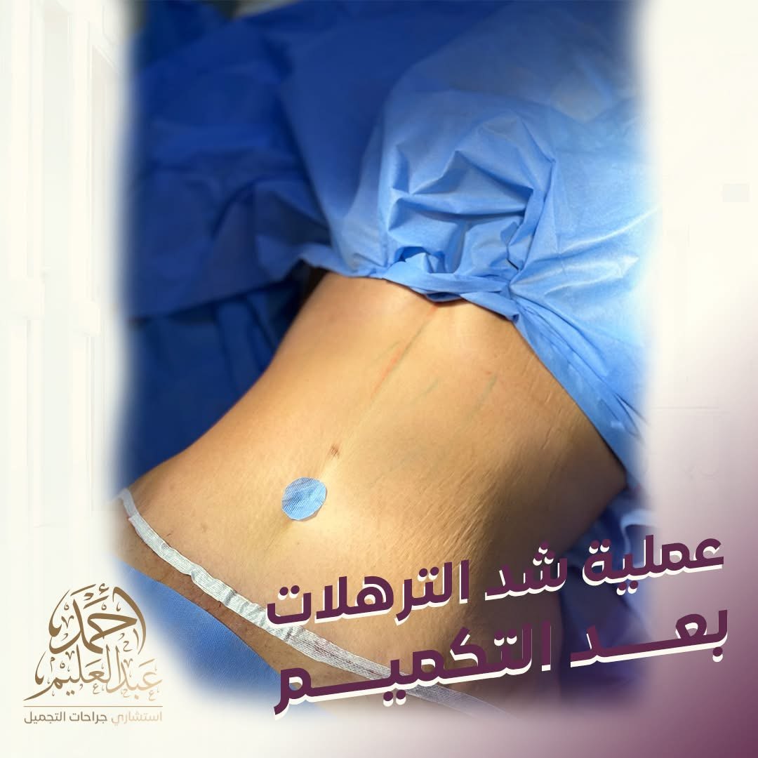 شد الترهلات بعد فقدان الوزن