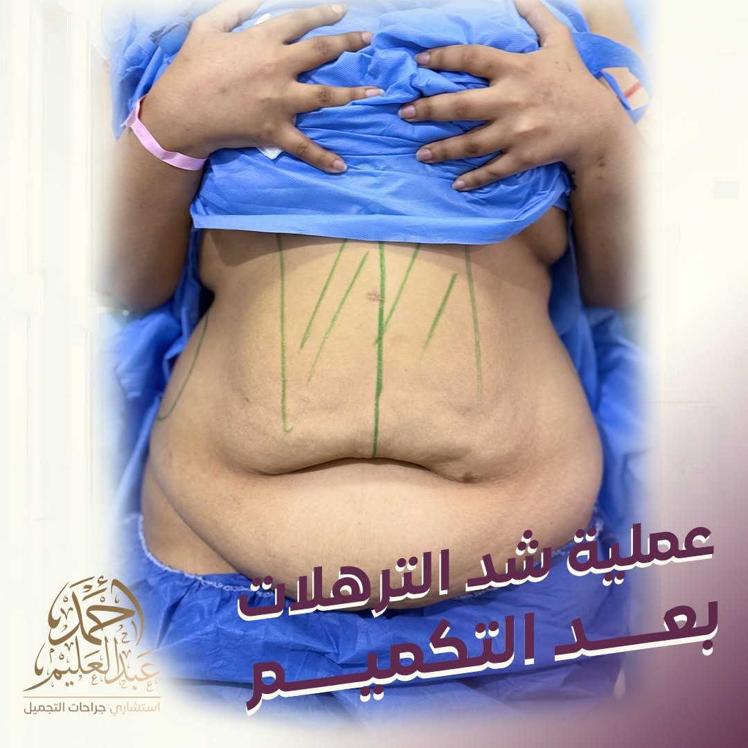 قبل شد الترهلات بعد التكميم