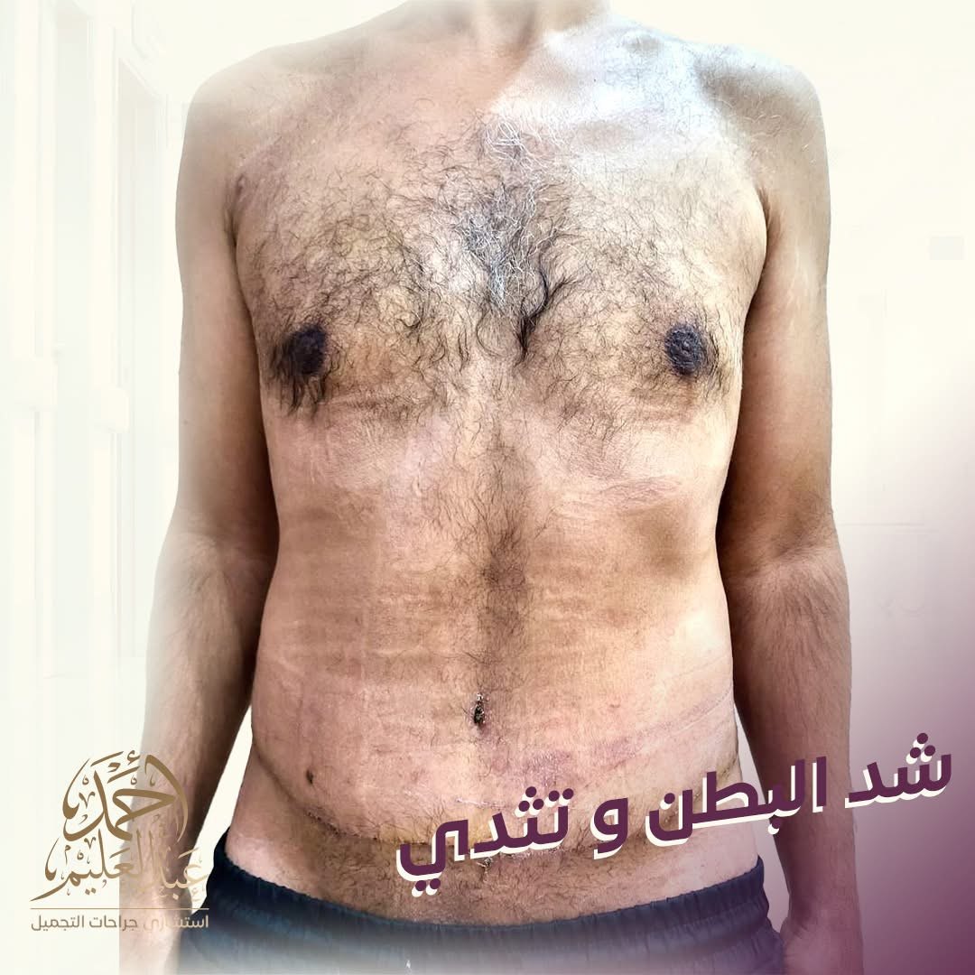 شفط الدهون وشد البطن