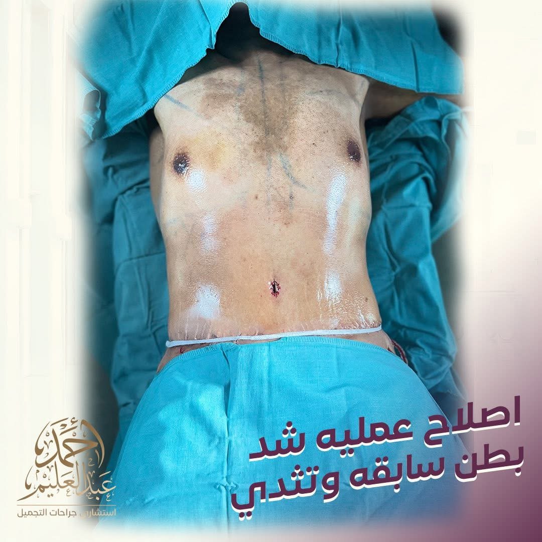 إصلاح عملية شد بطن سابقة في القاهرة