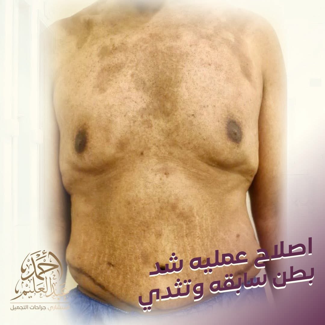 قبل إصلاح شد بطن سابق